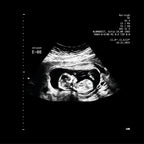 détail d'une échographie sonogram